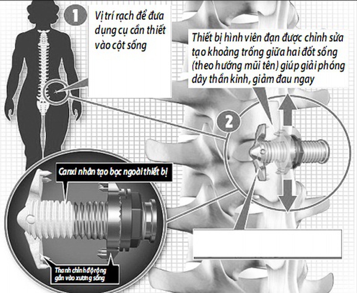 Thiết bị hình viên đạn được cấy ghép vào cột sống giúp giảm đau do hẹp ống sống.