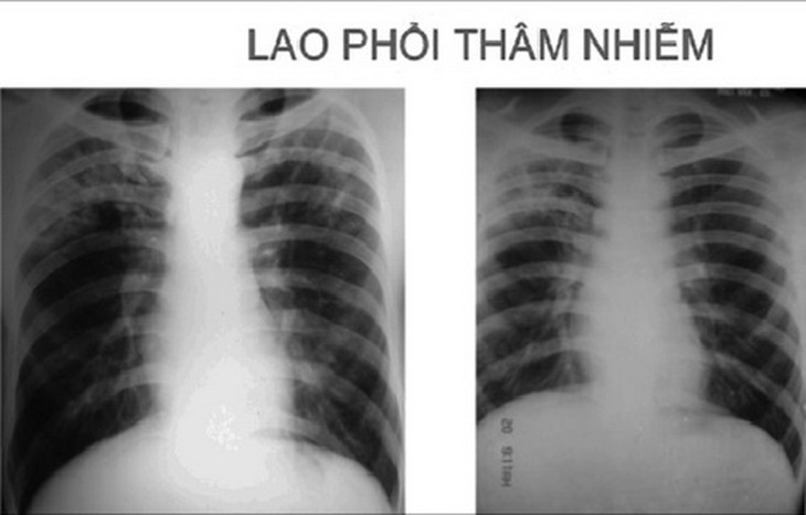 Hình ảnh tổn thương thâm nhiễm trên phim chụp Xquang phổi - Một dấu hiệu giúp chẩn đoán bệnh lao phổi.