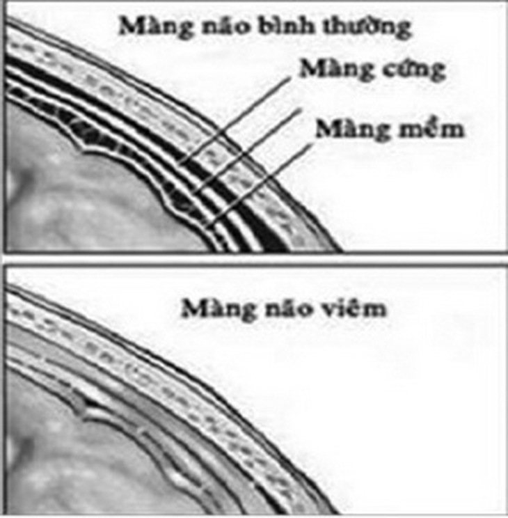 Phản ứng có hại của amoxicillin gây viêm màng não.