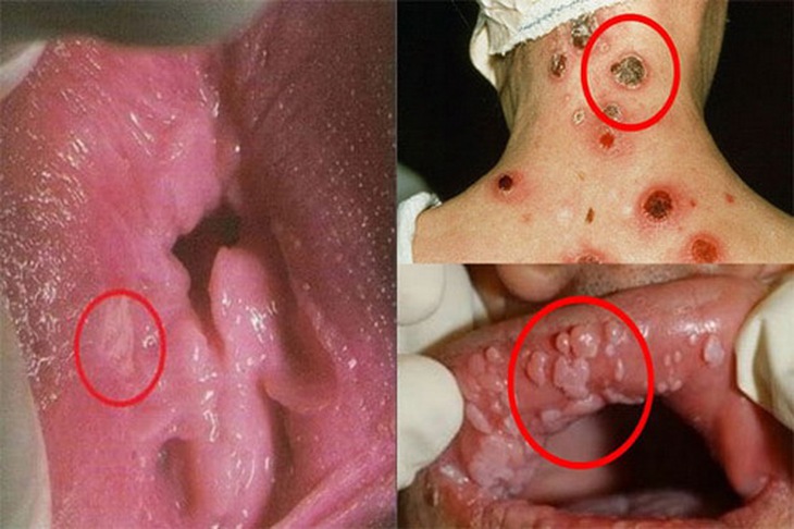 Một số hình ảnh bệnh lậu giang mai ở các bộ phận.