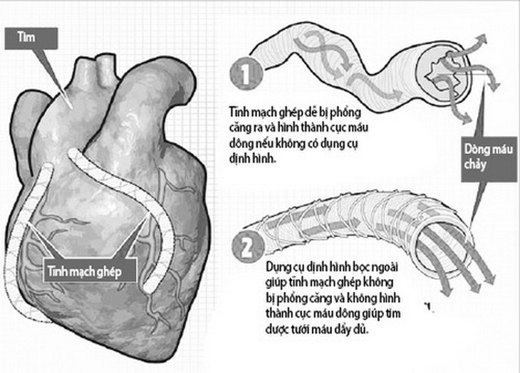 Mô phỏng thiết bị định hình bảo vệ mạch ghép tại tim.