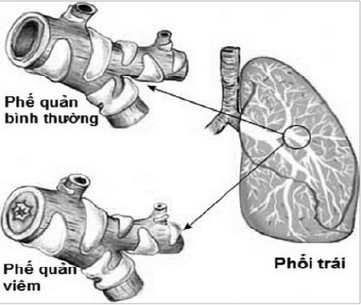 Khi thời tiết thay đổi, bệnh hen phế quản rất dễ tái phát.