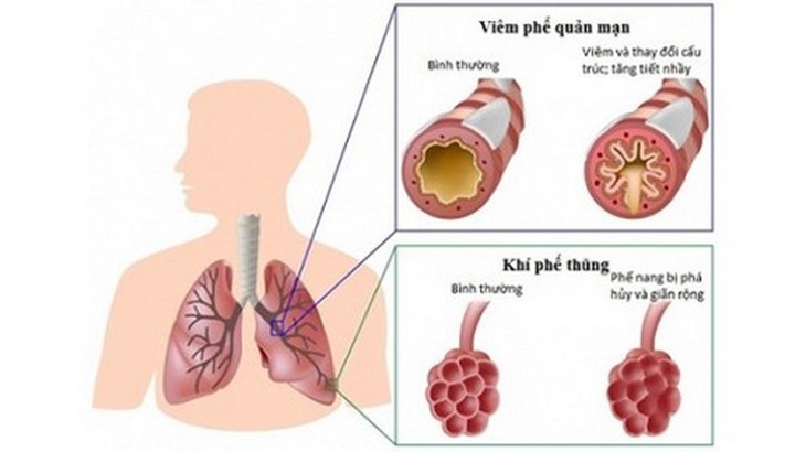 Bệnh phổi tắc nghẽn mạn tính - “Sát thủ vô hình”