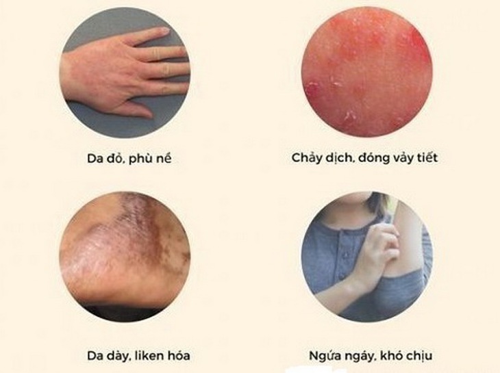 Một số dấu hiệu nhận biết triệu chứng của viêm da cơ địa.