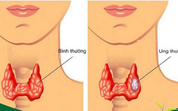 Tuyến giáp bình thường và ung thư tuyến giáp.