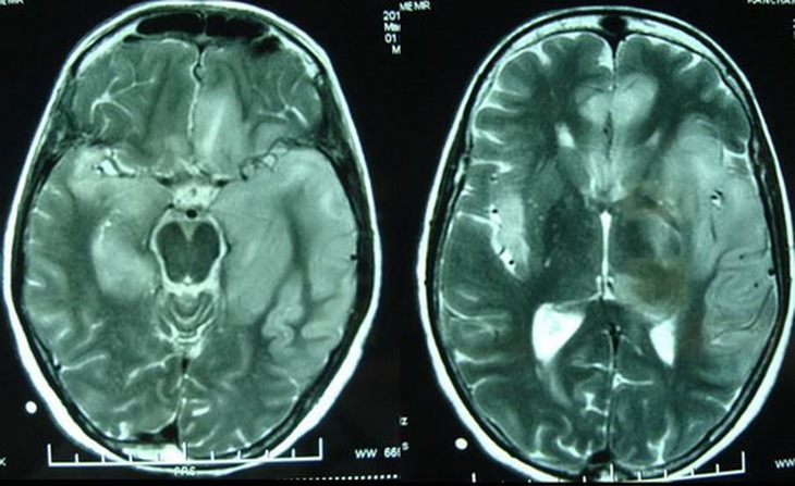 Hình ảnh MRI não điển hình của bệnh viêm não do virut Herpes.