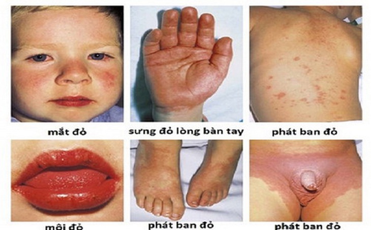 Các biểu hiện của bệnh Kawasaki.