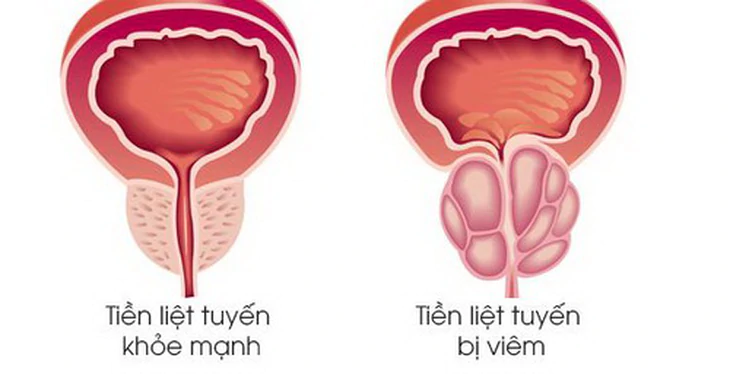 Viêm tuyến tiền liệt - Một nguyên nhân khiến nam giới đau khi yêu.