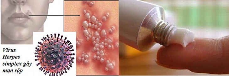Bệnh mụn rộp có thể lây qua tiếp xúc trực tiếp.