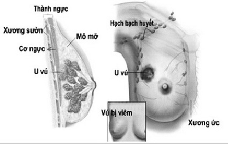 Lao vú có những triệu chứng dễ nhầm với ung thư vú, áp-xe vú...