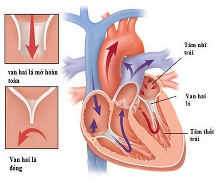 Nguy cơ do hở van động mạch chủ.