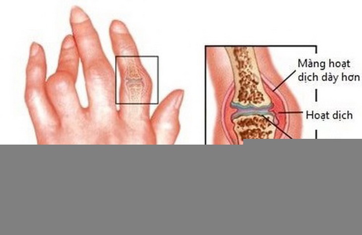 Biểu hiện viêm khớp dạng thấp ở ngón tay.