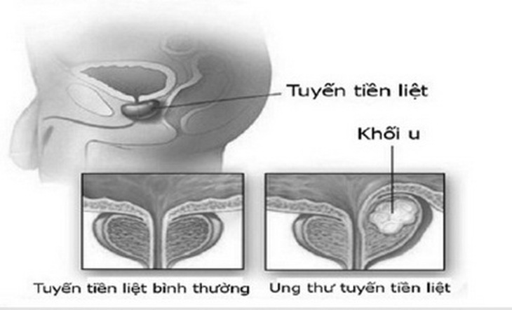 Tỷ lệ ung thư tuyến tiền liệt ngày càng gia tăng.