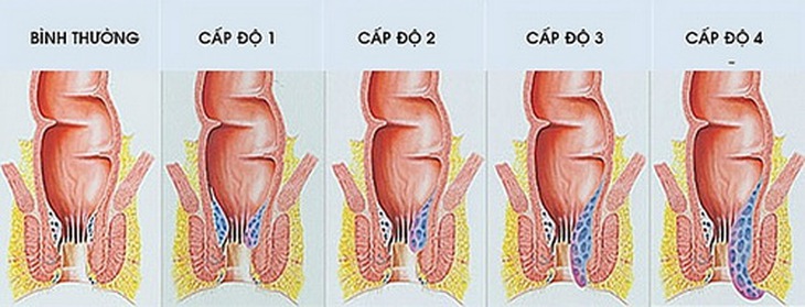 Tùy vào cấp độ bệnh bác sĩ sẽ chỉ định cách điều trị phù hợp.