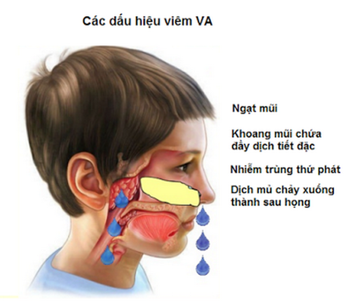 VA hay amidan nếu viêm quá phát sẽ gây nhiều biến chứng nguy hiểm.