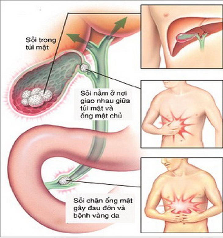 Hình ảnh sỏi mật.