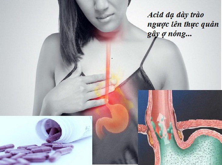 Có nhiều nguyên nhân gây ợ nóng như: ăn quá no hay do thuốc...