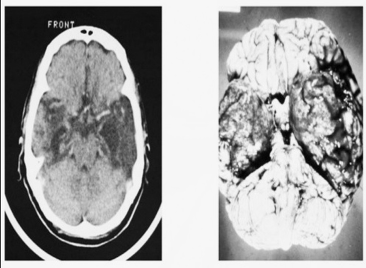 Hình ảnh MRI não điển hình của bệnh viêm não do Herpes.