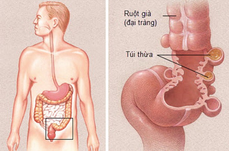 Khi túi thừa bị nhiễm trùng, có thể gây viêm túi thừa.