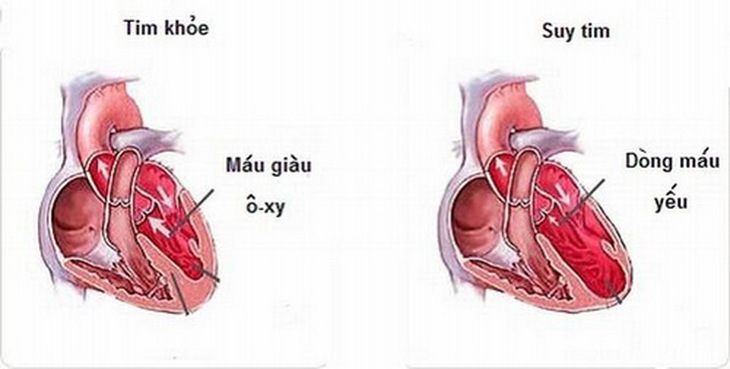 Suy tim, lượng máu đi nuôi cơ thể giảm.