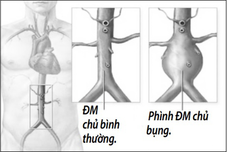 Phình động mạch chủ bụng là khi kích thước động mạch chủ tăng hơn 50% kích thước bình thường.
