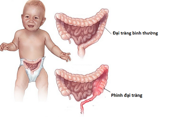 Phình đại tràng ở trẻ nhỏ rất dễ phát hiện và điều trị.