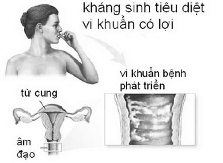 Mất cân đối hệ vi khuẩn cũng làm “vùng kín” bị viêm nhiễm.
