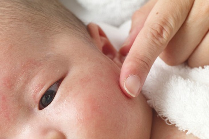 Triệu chứng rắc rối nhất của chàm là ngứa ngáy khó chịu, làm cho bệnh nhi quấy khóc liên tục, không chịu ngủ.
