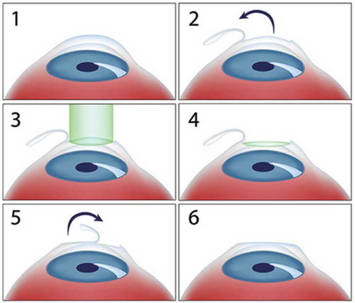 Các bước trong phương pháp phẫu thuật Lasik.