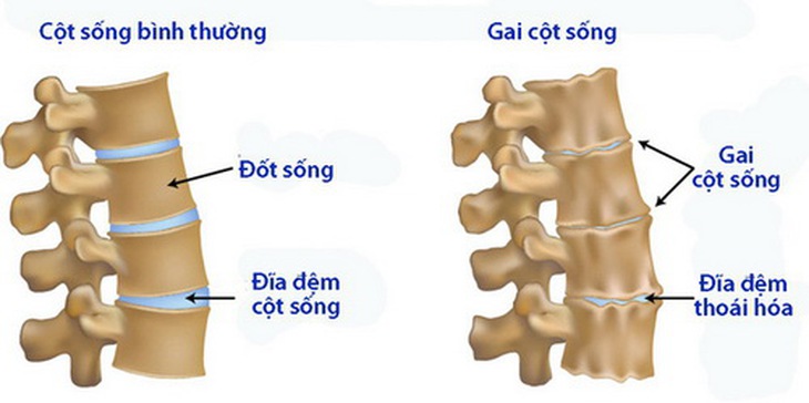 Hình ảnh Xquang gai cột sống.