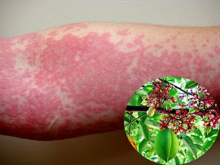 Dị nguyên thường gặp là phấn hoa, nấm mốc, côn trùng…