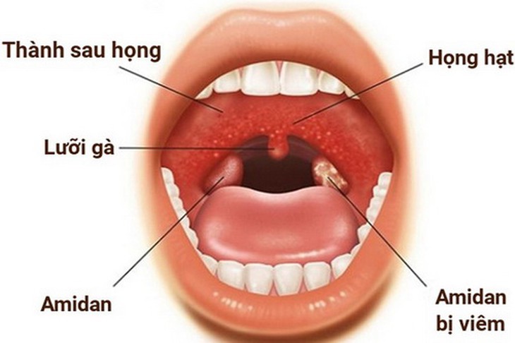 Hình ảnh amidan.