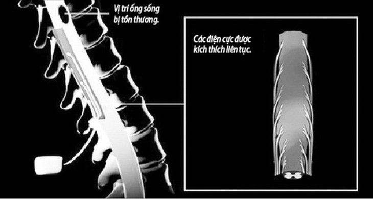 Mô phỏng vị trí đặt điện trong ống sống điều trị cho người bị liệt.