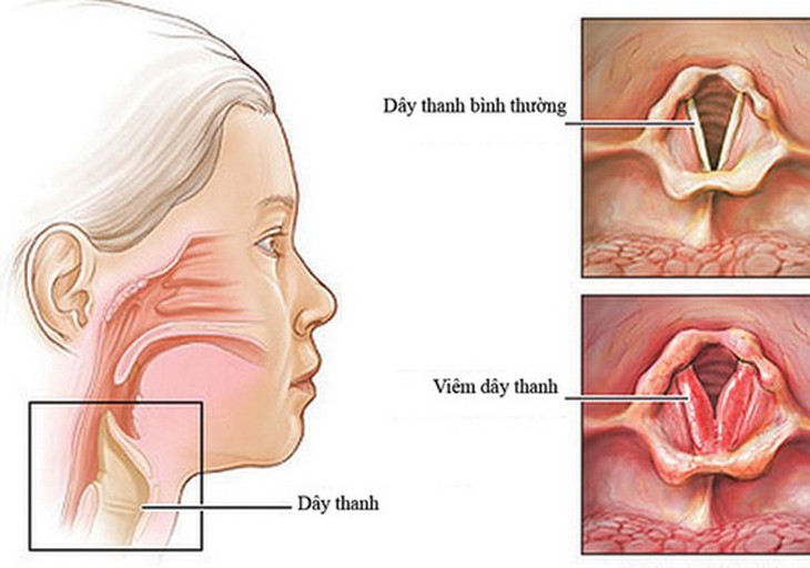 Viêm dây thanh dễ gây khàn tiếng, thậm chí mất tiếng.