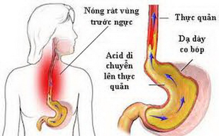 Khi bị trào ngược dạ dày - thực quản, nên điều trị sớm, tránh gây biến chứng nguy hiểm.