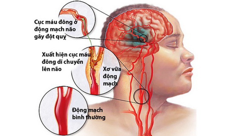 Hình ảnh cục máu đông gây đột quỵ.