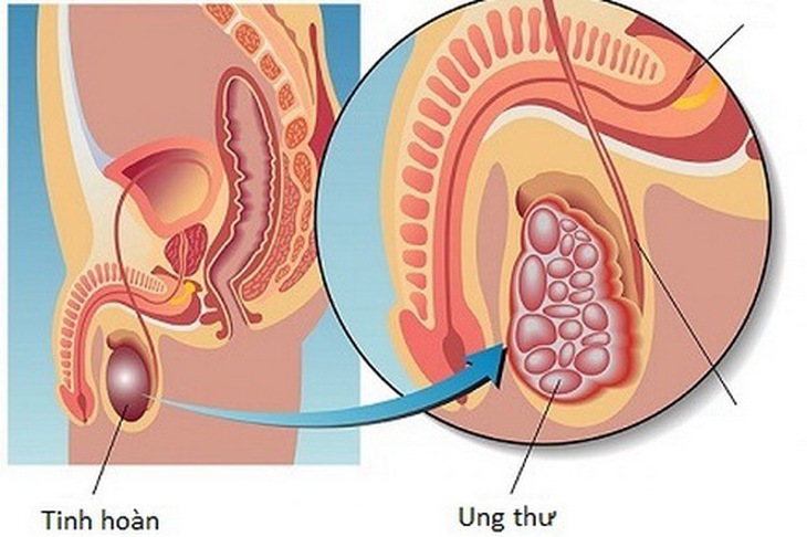 Tỷ lệ chữa khỏi ung thư tinh hoàn khá cao.
