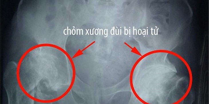 Tổn thương cơ bản của bệnh là hoại tử nhân của chỏm xương đùi.
