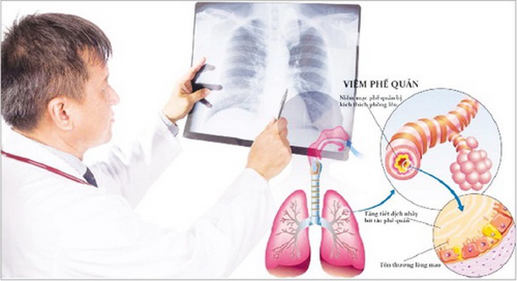 Ðông y gọi viêm phế quản là khái thấu, đàm ẩm. Nguyên nhân  do ngoại cảm phong hàn, phong nhiệt, khi táo hoặc do công năng của 3 tạng phế, tỳ, thận giảm sút.