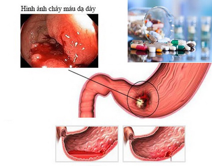 Xuất huyết tiêu hoá là một biến chứng nặng khi dùng thuốc.