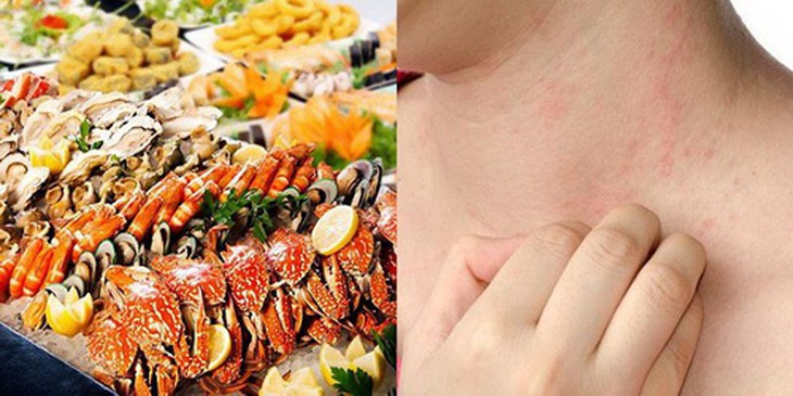 Người có cơ địa dị ứng cần cẩn trọng khi ăn hải sản.