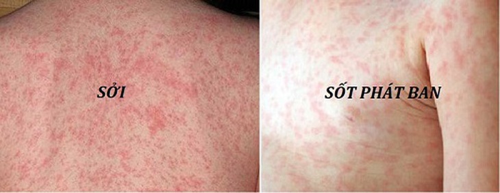 Sởi và sốt phát ban là hai bệnh khác nhau nhưng có biểu hiện ban đầu tương đồng.
