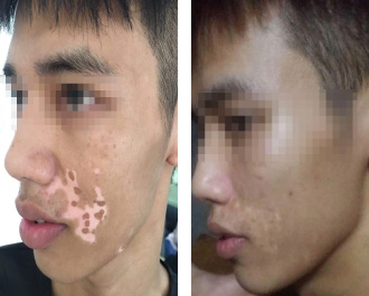Hình ảnh bệnh nhân trước và sau điều trị ghép tế bào sắc tố.