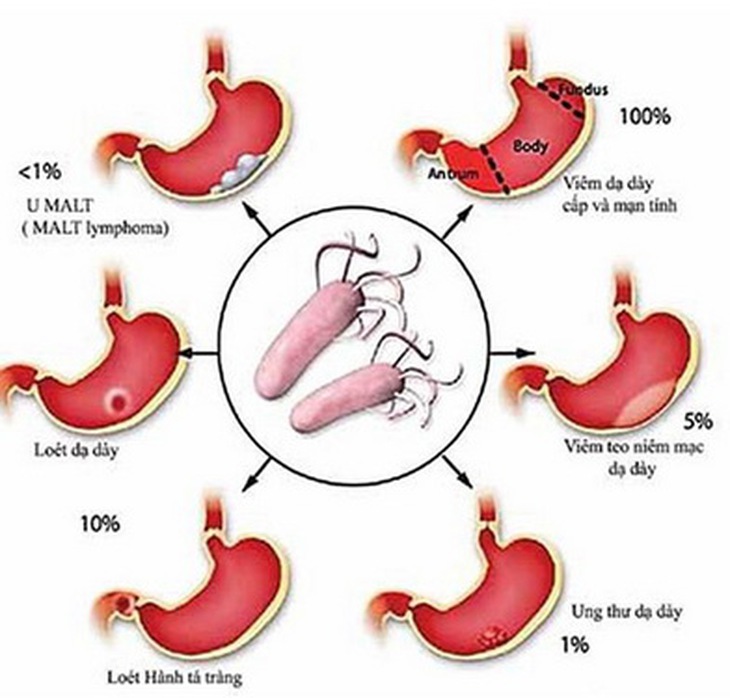 Hình ảnh minh họa về vi khuẩn HP gây bệnh cho dạ dày như thế nào.