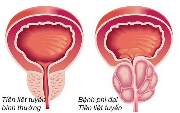Hình ảnh tuyến tiền liệt bị phì đại.