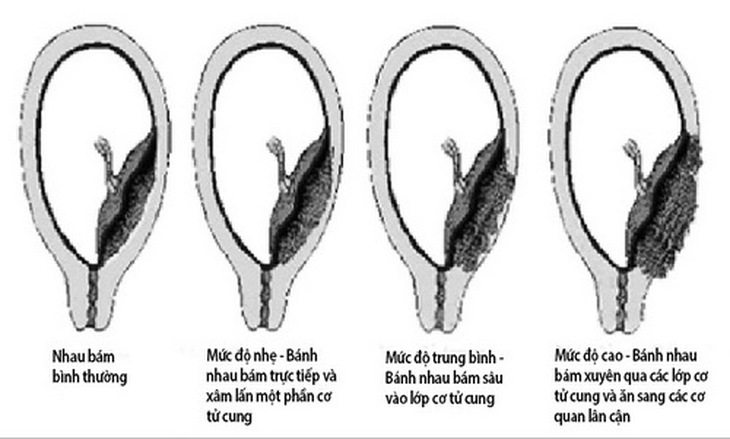 Các mức độ rau cài răng lược.