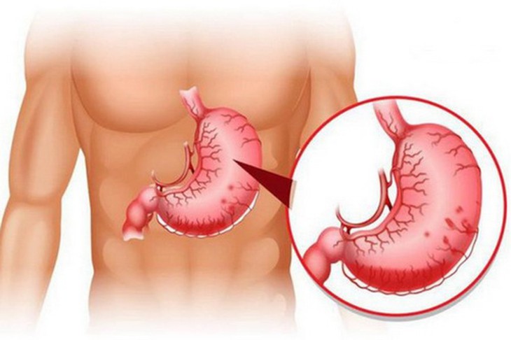 Xuất huyết tiêu hóa là bệnh thường gặp. Nếu không điều trị kịp thời sẽ có nguy cơ đe dọa tính mạng.