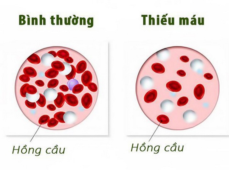 Số lượng hồng cầu ở người bình thường và người thiếu máu.