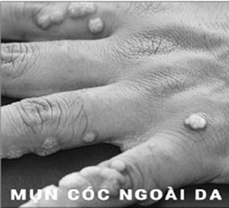 Các tổn thương khi bị mụn cóc có thể lây nhiễm khi có sự tiếp xúc với dịch tiết của tổn thương.