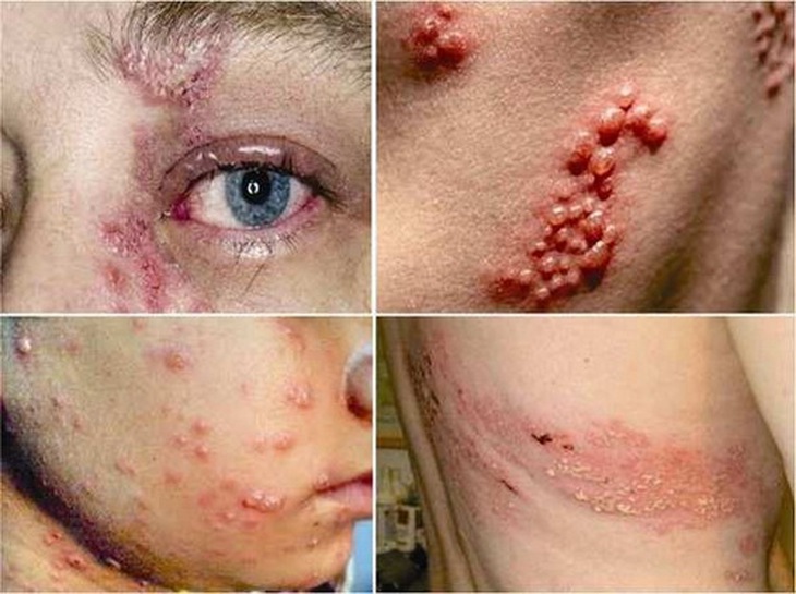 Bệnh Zona mắt là tình trạng mụn nước xuất hiện trong và xung quanh mắt.